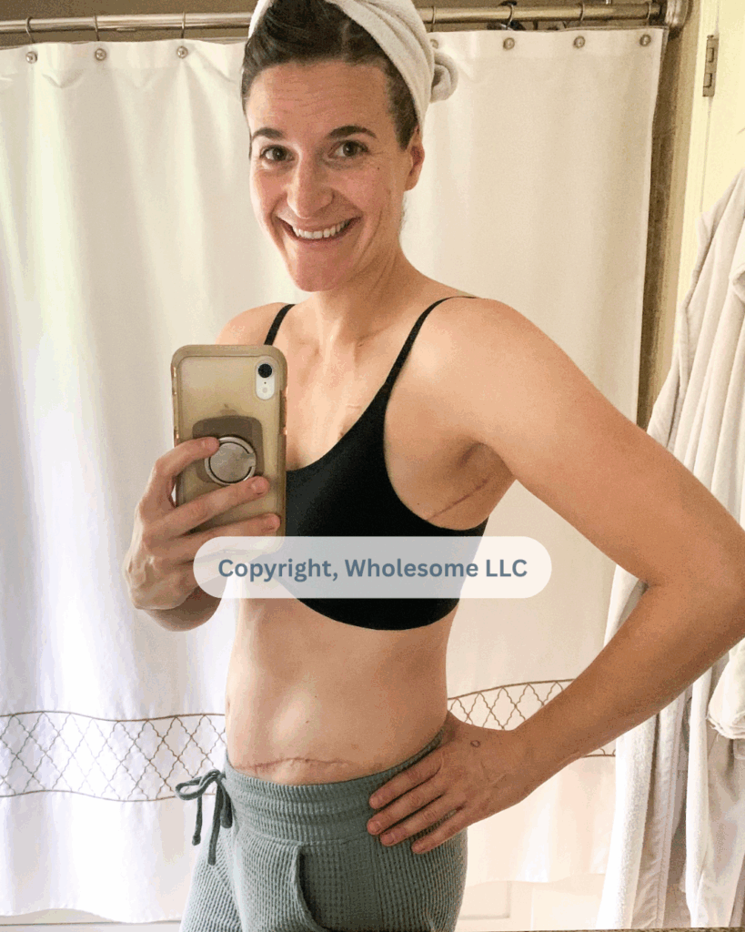 My scars after 10 weeks after DIEP flap reconstruction.